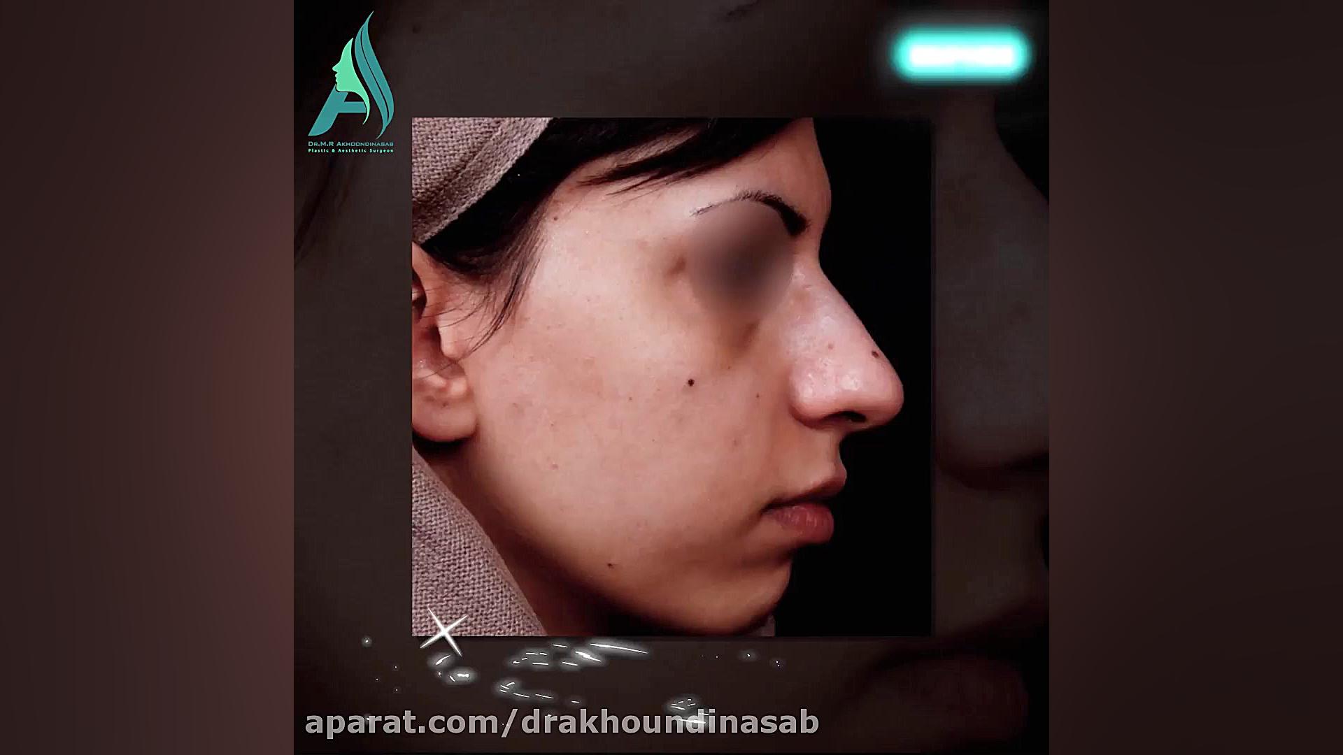 جراحی بینی استخوانی به شکل طبیعی دکتر محمدرضا آخوندی نسب-فوق تخصص جراحی پلاستیک