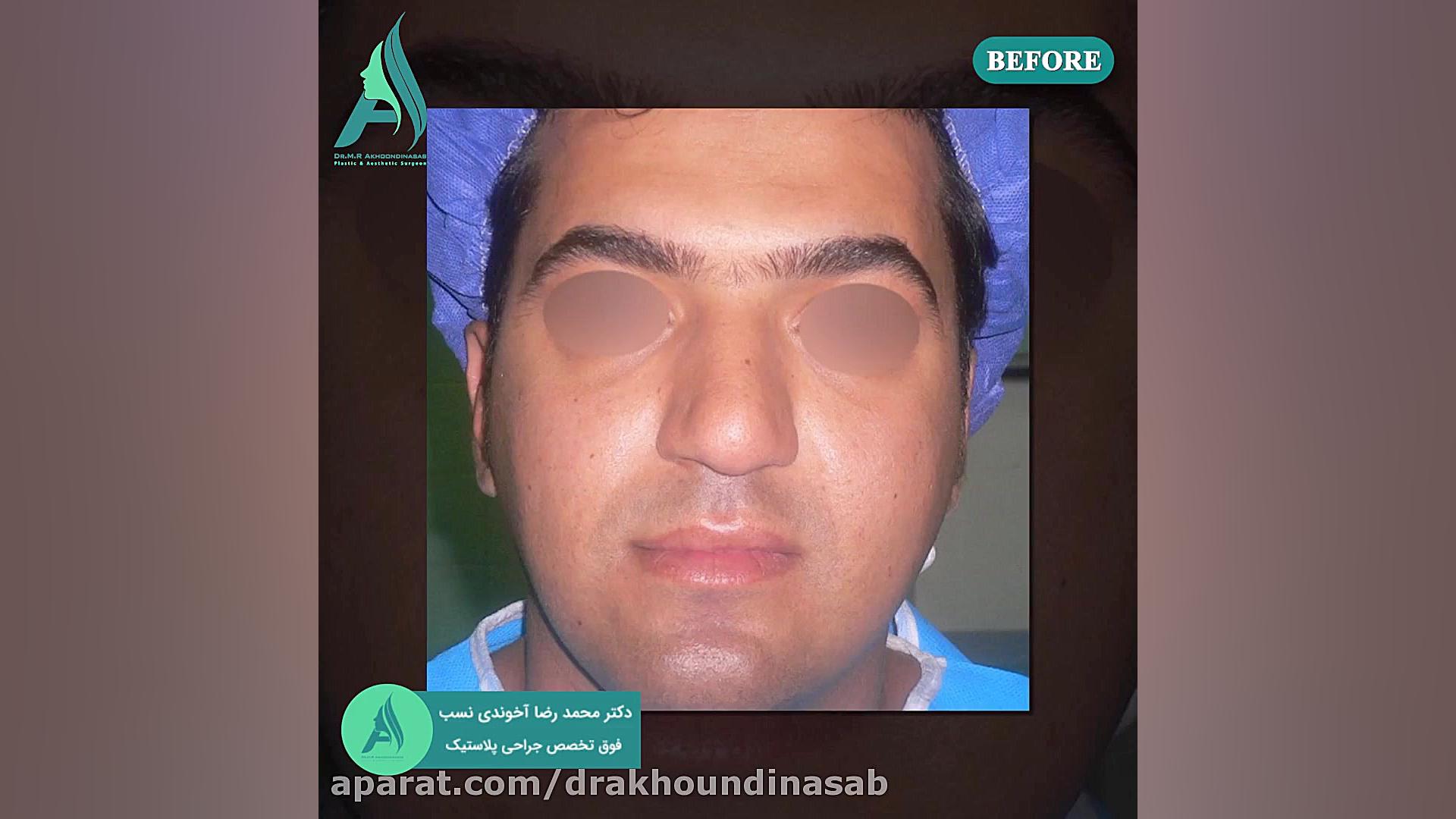 جراحی بینی گوشتی دکتر محمدرضا آخوندی نسب-فوق تخصص جراحی پلاستیک