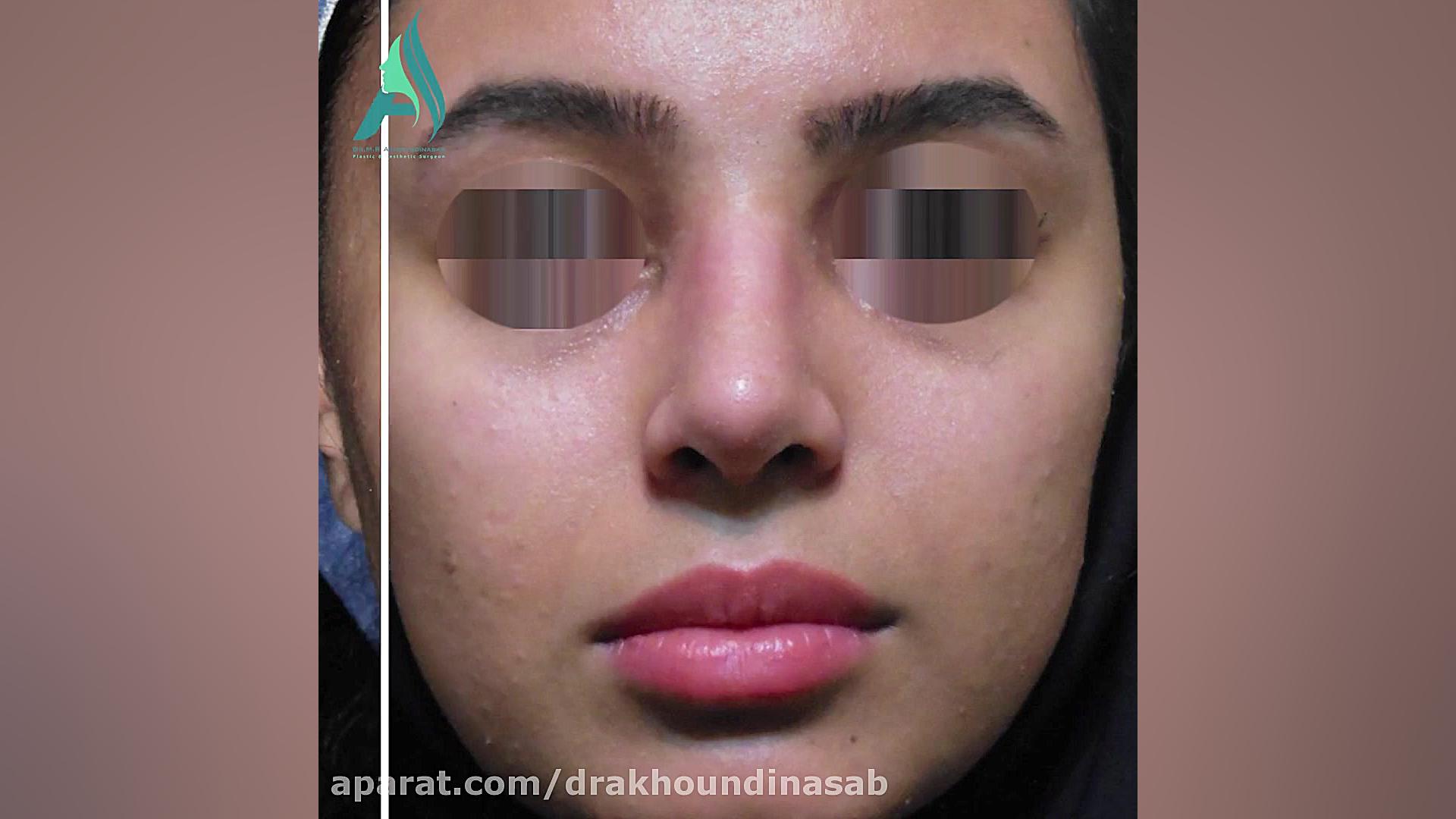 جراحی بینی استخوانی به صورت طبیعی دکتر محمدرضا آخوندی نسب-فوق تخصص جراحی پلاستیک