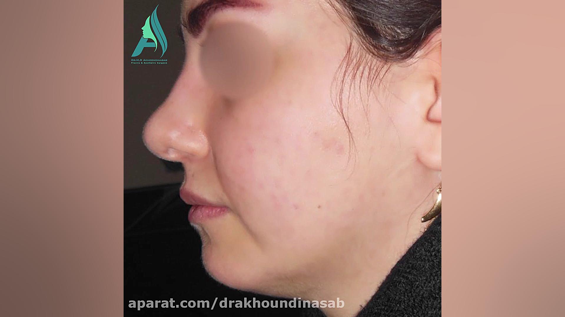 پروتز چانه از برش داخل دهان دکتر محمدرضا آخوندی نسب-فوق تخصص جراحی پلاستیک