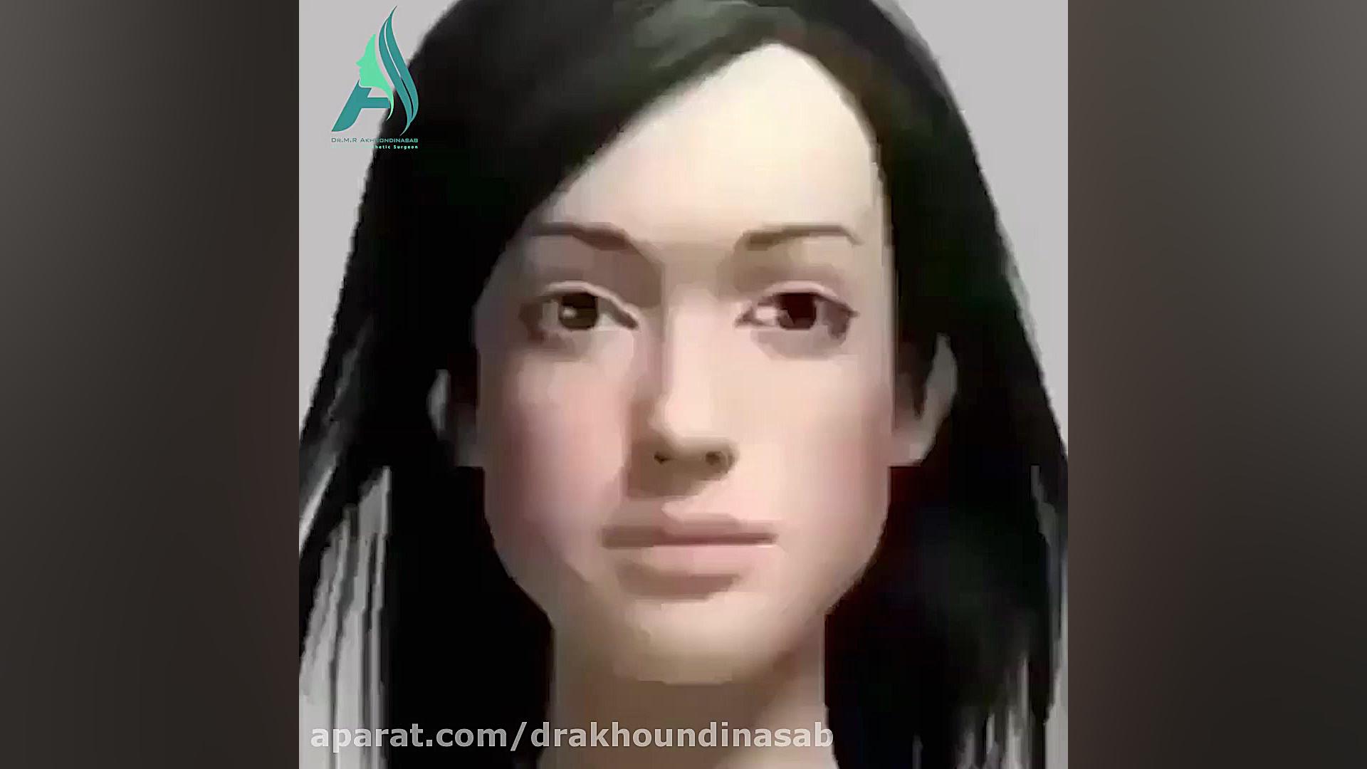 جراحی بوکال فت راهی برای از بین بردن چاقی ناخواسته صورت دکتر محمدرضا آخوندی نسب-فوق تخصص جراحی پلاستیک