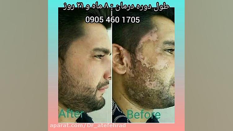 درمان قطعی پیسی_ویتیلیگو با دکتر خیراندیش مریم سعادت