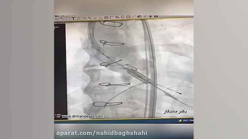 جراحی Tavi کلونینگ درمانی