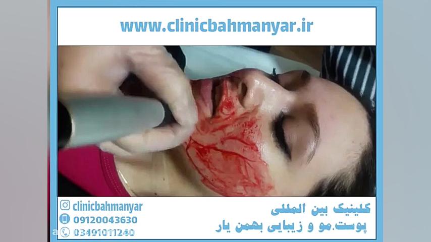 جوانسازی پوست با میکرونیدلینگ بیماری کلوتزوکس