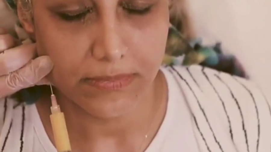 فیلم واقعی تزریق چربی صورت دکتر سوسن احمدی پیر شهید