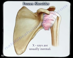 شانه منجمد (یخ زده) چیست و چگو...