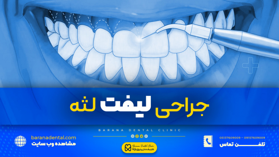 "جراحی لیفت لثه با لیزر" اندودنتیکس