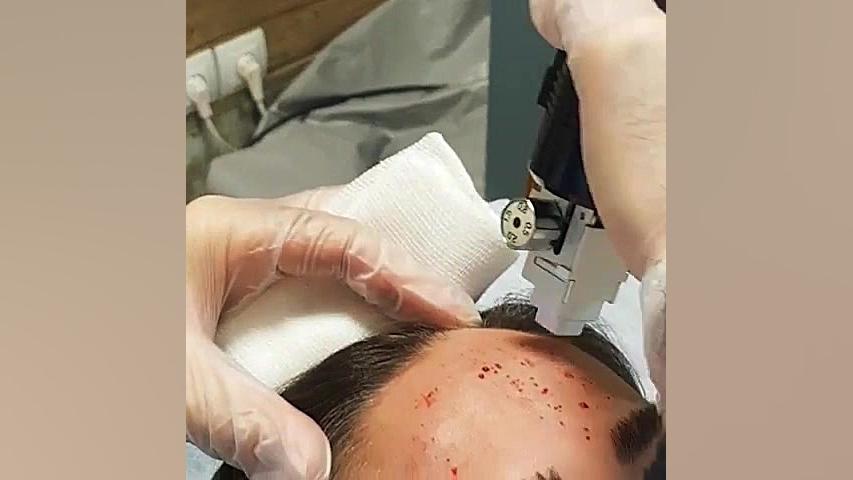 لیزر آر اف فرکشنال بیولوژی پرتوی