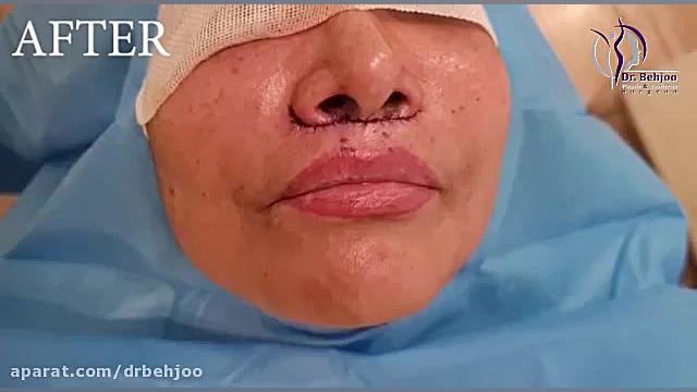 لیفت سانترال لب دکتر شاهین بهجو - فوق تخصص جراحی پلاستیک