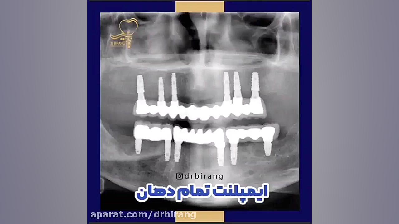 ایمپلنت کل دهان یا فول موس چیست؟ دکتر احسان بیرنگ