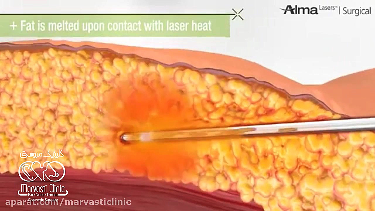 پیکرتراشی و لیپوساکشن با لیزر دستگاه DNA-Chip