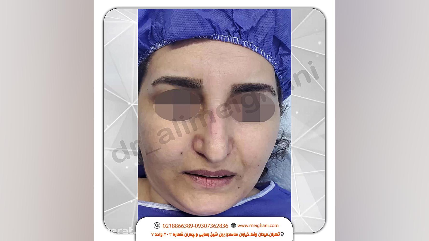 جراحی زیبایی بینی به روش تیپ پلاستی با بیحسی موضعی کلینیک لیزر