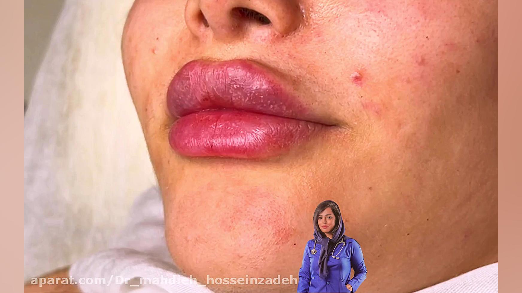 تزریق لب روسی در رشت دکتر مهدیه حسین زاده کلینیک زیبایی رشت دکتر مهدیه حسین زاده