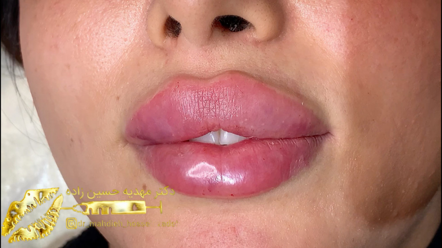 تزریق ژل لب روسی در رشت دکتر مهدیه حسین زاده کلینیک زیبایی رشت دکتر مهدیه حسین زاده
