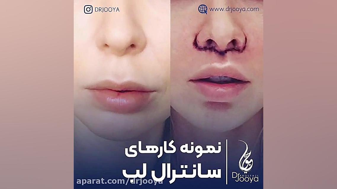 نمونه کارهای سانترال لب دکتر جویا | بهترین متخصص زیبایی اصفهان دکتر ابوالفضل جویا