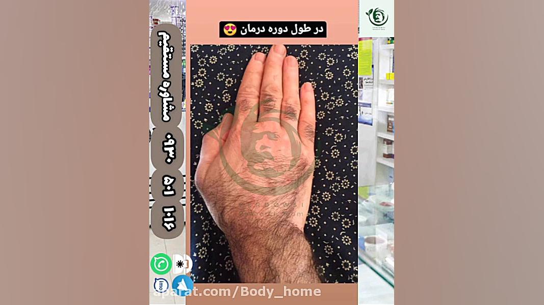 درمان قطعی ویتیلیگو در تهران تام کروز