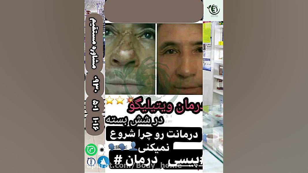 درمان قطعی ویتیلیگو در اصفهان پیسی برص بهاق ویتیلایگو کیت وینسلت
