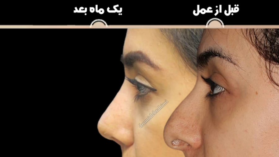 جراحی زیبایی بینی توسط دکتر امید ابراهیمی بهترین جراح بینی در تهران دکتر امید ابراهیمی