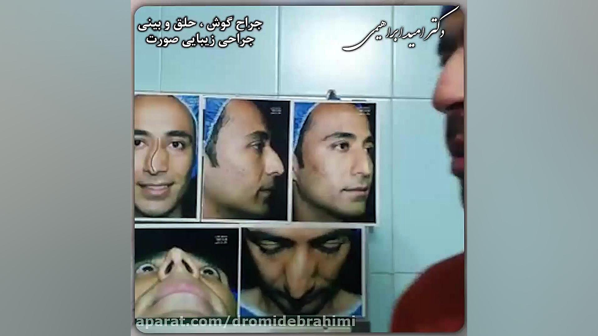 جراحی انحراف شدید بینی توسط دکتر امید ابراهیمی بهترین جراح بینی در تهران دکتر امید ابراهیمی
