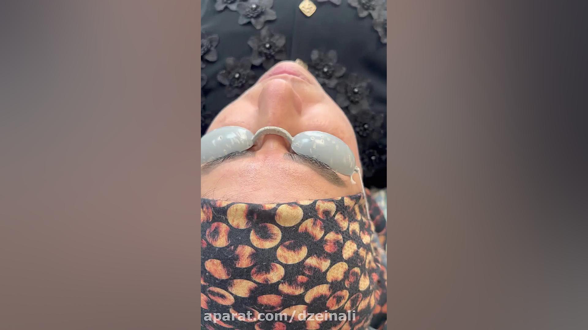 بهبود قابل توجه لک وکک و مک صورت دکتر فرحناز زینعلی - متخصص پوست، مو، زیبایی زنجان