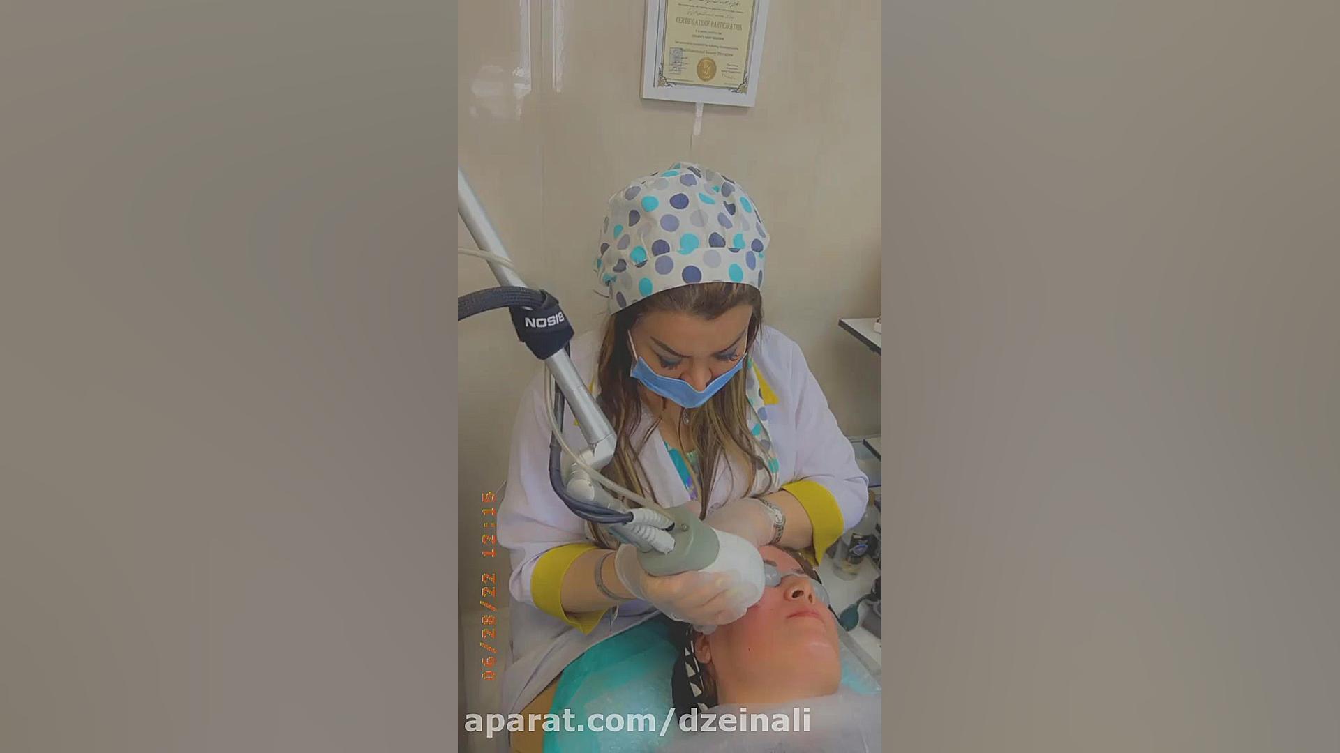 انجام لیزر برای رفع دائمی و بدون اسکار خال های صورت دکتر فرحناز زینعلی - متخصص پوست، مو، زیبایی زنجان