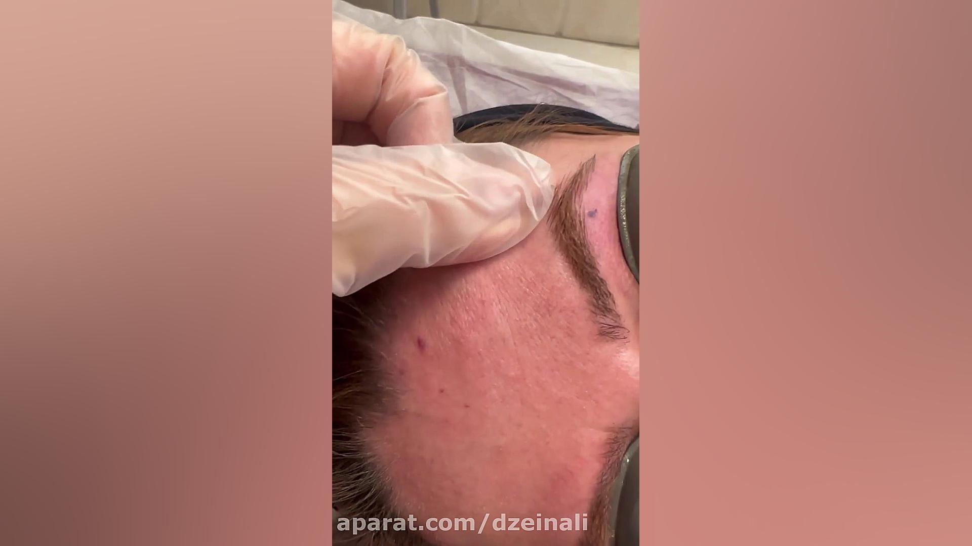 تنها لیزر اندیگ الکس امریکایی سایناشور برای درمام قطعی خالها و ضایعات عروقی دکتر فرحناز زینعلی - متخصص پوست، مو، زیبایی زنجان