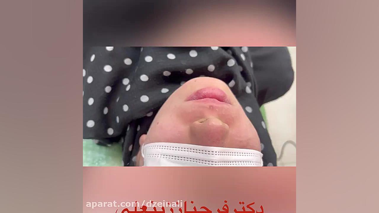 بهبود عالی لکها و کک و مک پوست با استفاده از دو نوع لیزر پیشرفته دکتر فرحناز زینعلی - متخصص پوست، مو، زیبایی زنجان