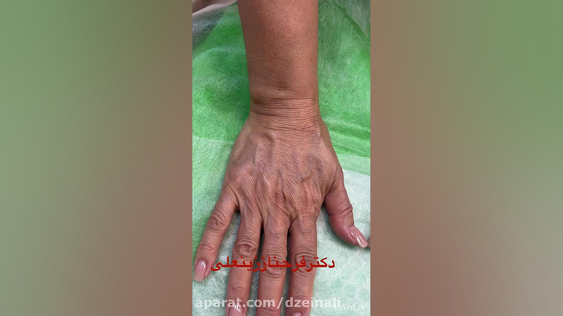 تزریق فیلر هیالورونیک اسید جوانساز به پشت دستها برای زیبایی و جوانی دوباره دستها دکتر فرحناز زینعلی - متخصص پوست، مو، زیبایی زنجان