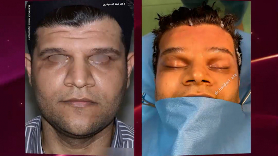 لیفت آندوسکوپی پیشانی تزریق چربی