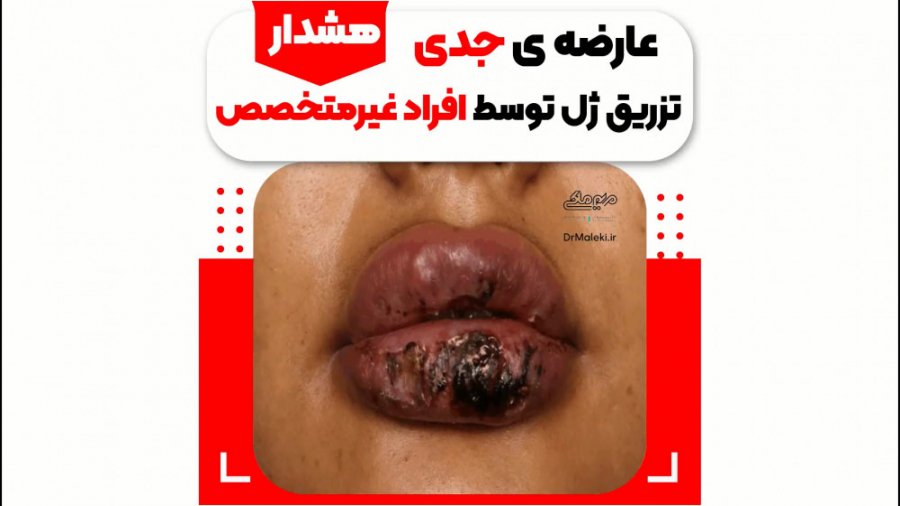 عارضه ی جدی تزریق ژل توسط افراد غیر متخصص دکتر مریم ملکی - کلینیک پوست و مو و زیبایی هور