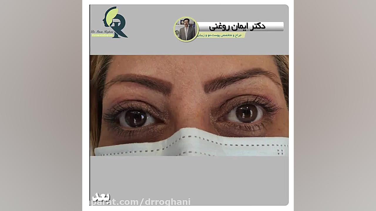 جراحی بلفاروپلاستی بر روی هر دو پلک بالا دکتر ایمان روغنی جراح و متخصص پوست و مو