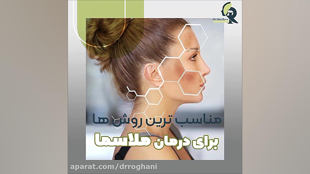 مناسب ترین روش ها برای درمان ملاسما دکتر ایمان روغنی جراح و متخصص پوست و مو