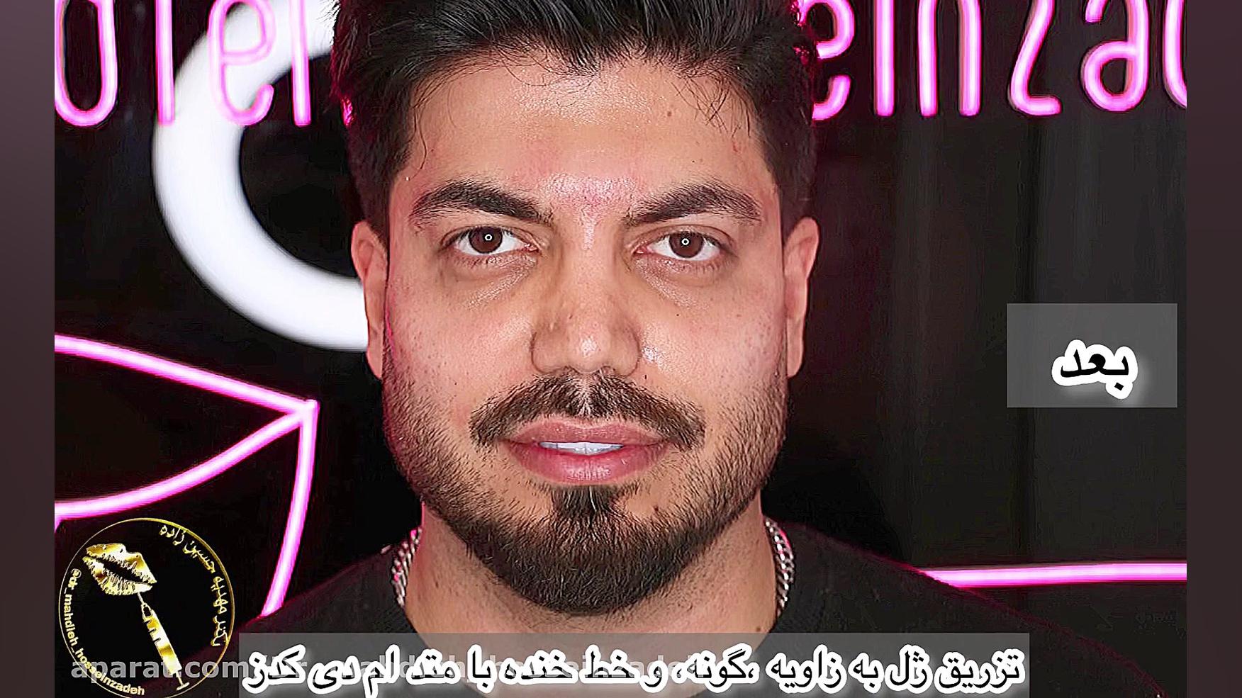 تزریق ژل به زاویه،گونه و خط خند در رشت کلینیک زیبایی رشت دکتر مهدیه حسین زاده