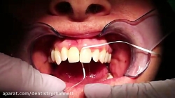 چگونگی استفاده از دنتال فلاس د...