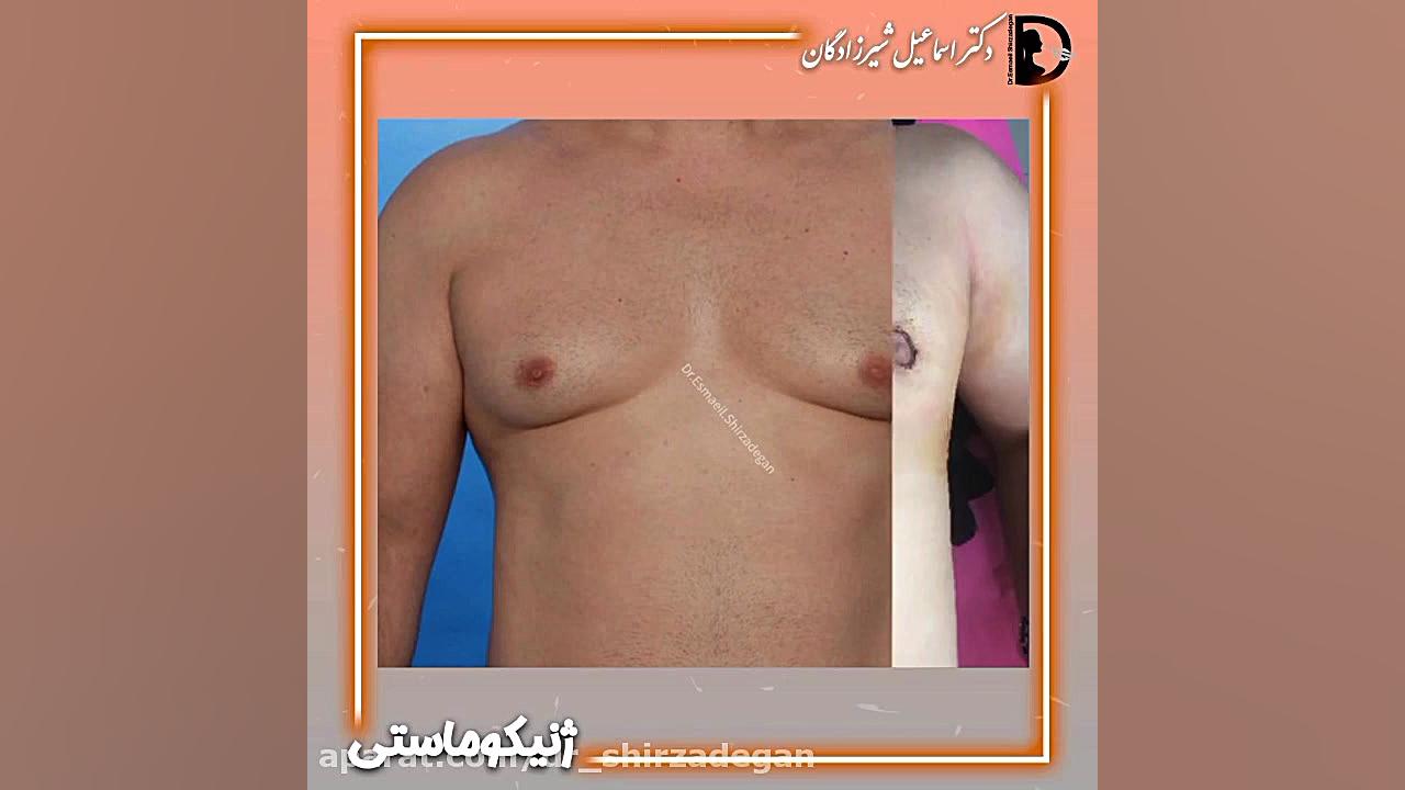 ژنیکوماستی دکتر اسماعیل شیرزادگان
