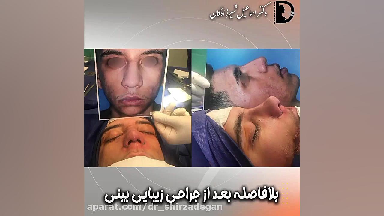 بلافاصله بعد از جراحی بینی دکتر اسماعیل شیرزادگان