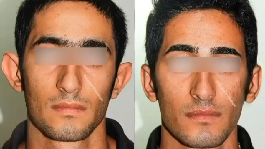 اتوپلاستی گوش برجسته دکتر اسماعیل شیرزادگان