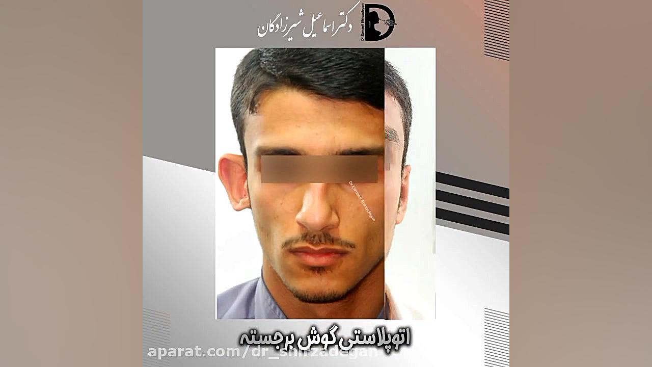 جراحی گوش برجسته دکتر اسماعیل شیرزادگان