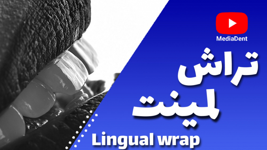 تراش لمینیت - lingual wrap - قسمت سوم دندانپزشک زیبایی