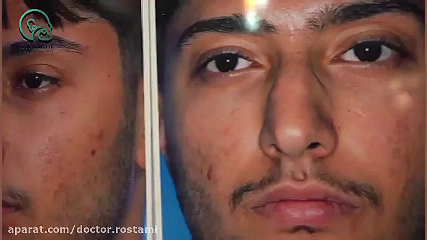 جراحی زیبایی بینی با انحراف زیاد(بخش سوم) کلینیک دندانپزشکی