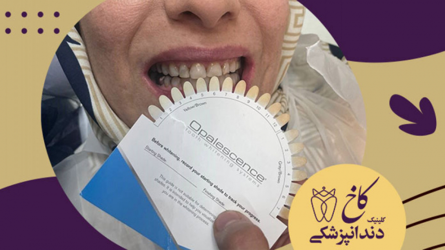 درمان بلیچینگ توسط دندانپزشک پیلینگ