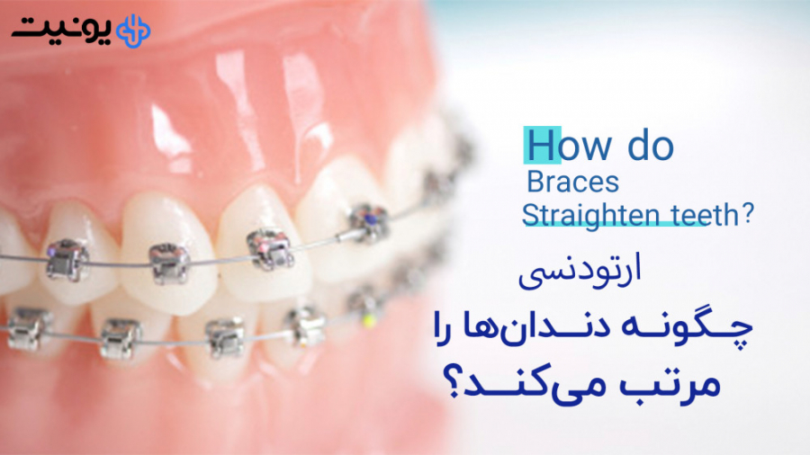 ارتودنسی چگونه دندان ها را مرتب می کند؟ لباس اگزواسکلتون پزشکی