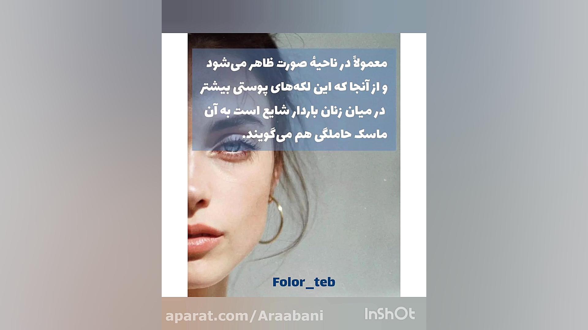 لکه پوستی صورت در بارداری سیده سارا موسوی عربانی