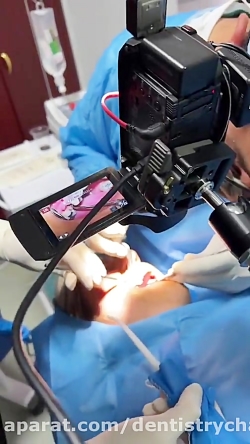 fresh socket implantation با کمک تکنولوژی دیجیتال ( دکتر جهانگیرنیا )