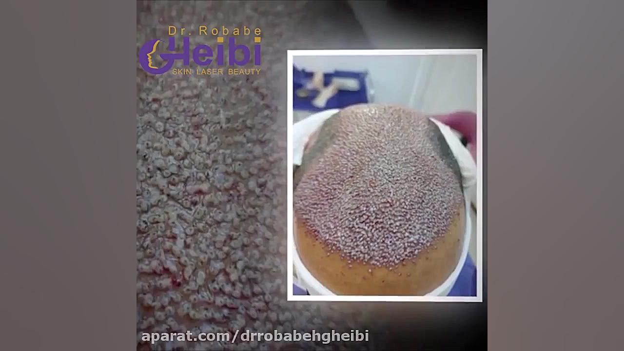 فیلم کاشت مو پر تراکم دکتر ربابه غیبی