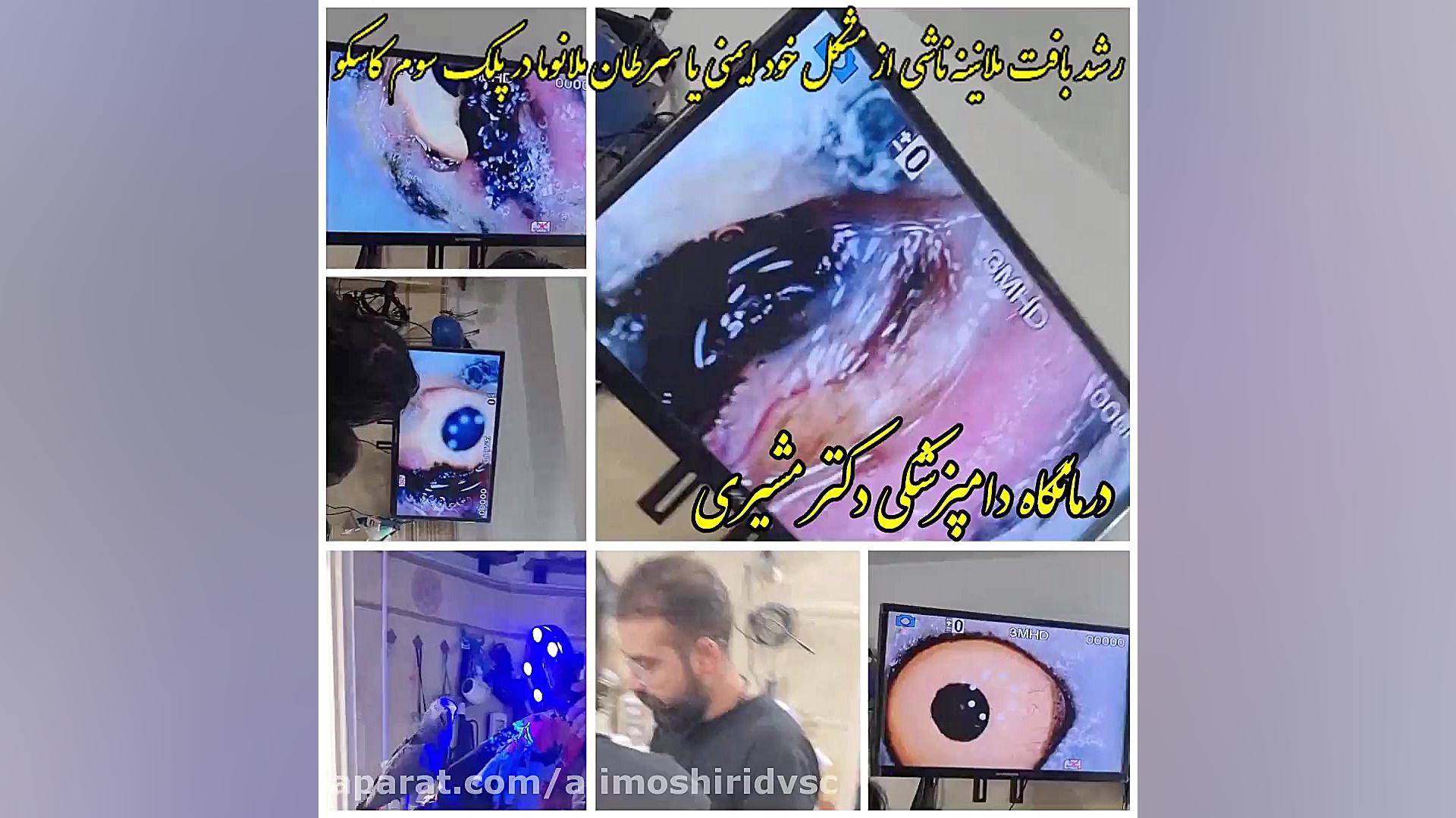 ملانوما در کاسکو چای خور چای