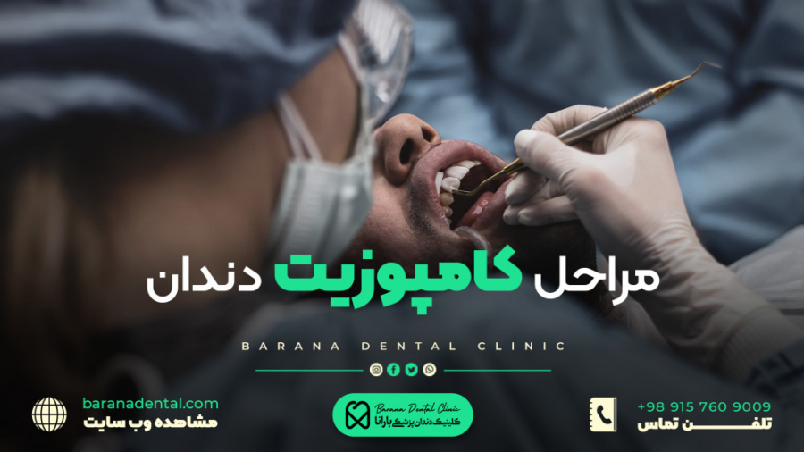 "مراحل کامپوزیت دندان در کلینیک دندانپزشکی بارانا" رزولین