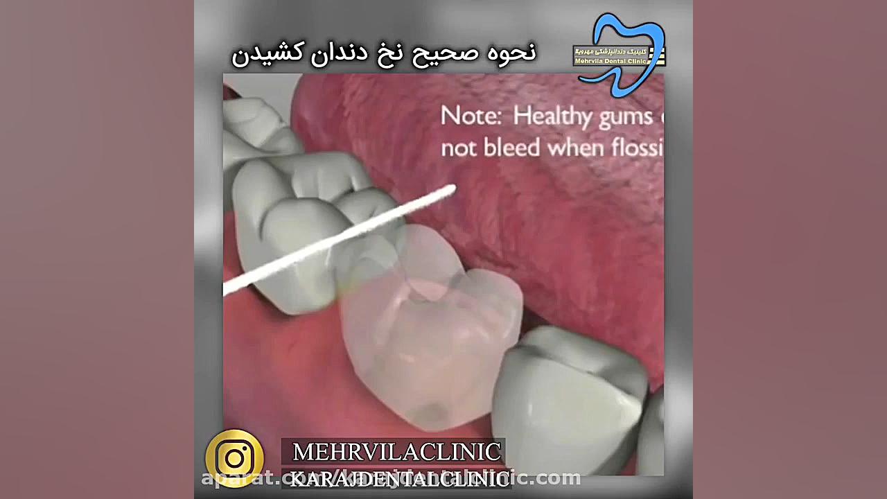 فیلم جرم گیری دندان انسریدا