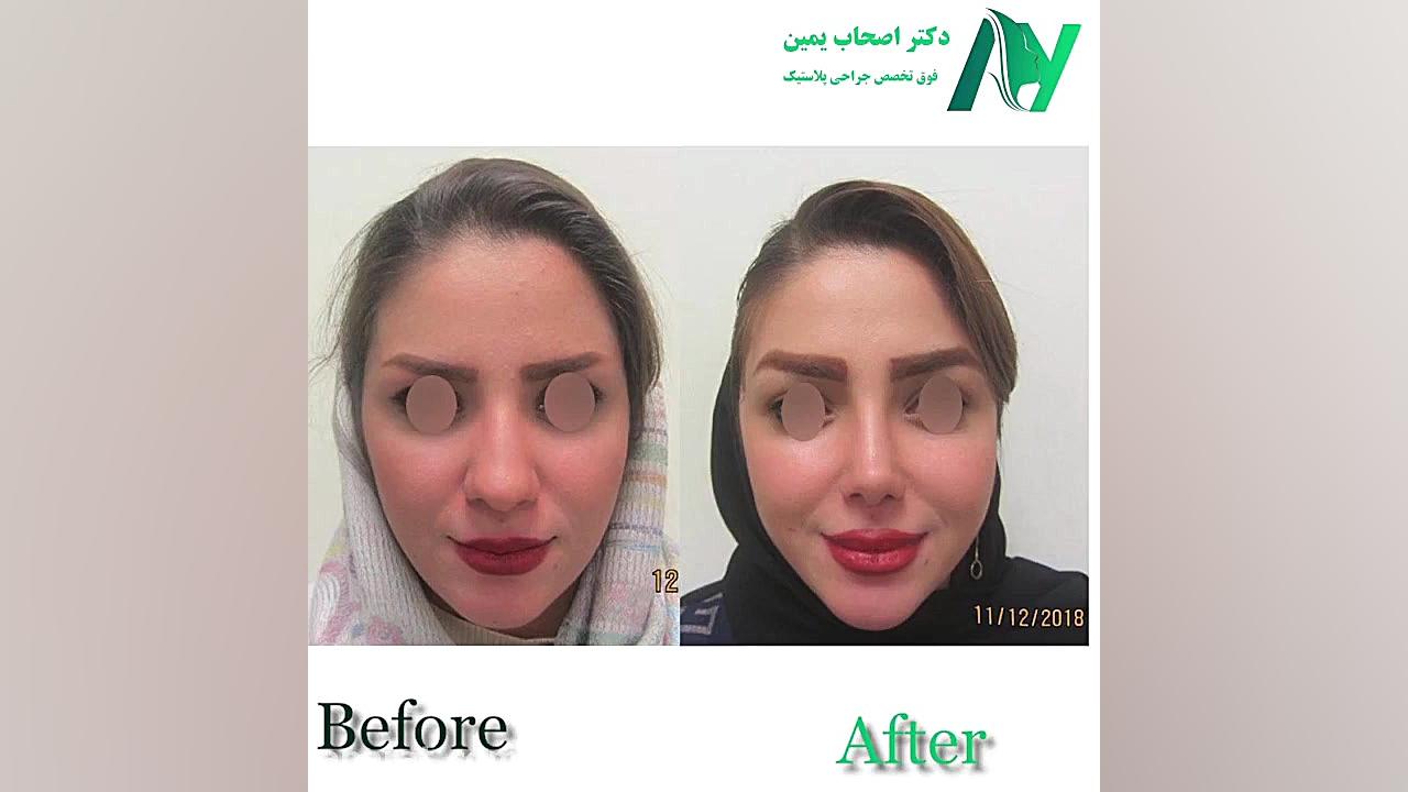 فیلم دیدنی از جراحی زیبایی بینی دکتر محمودرضا اصحاب یمین - فوق تخصص پلاستیک