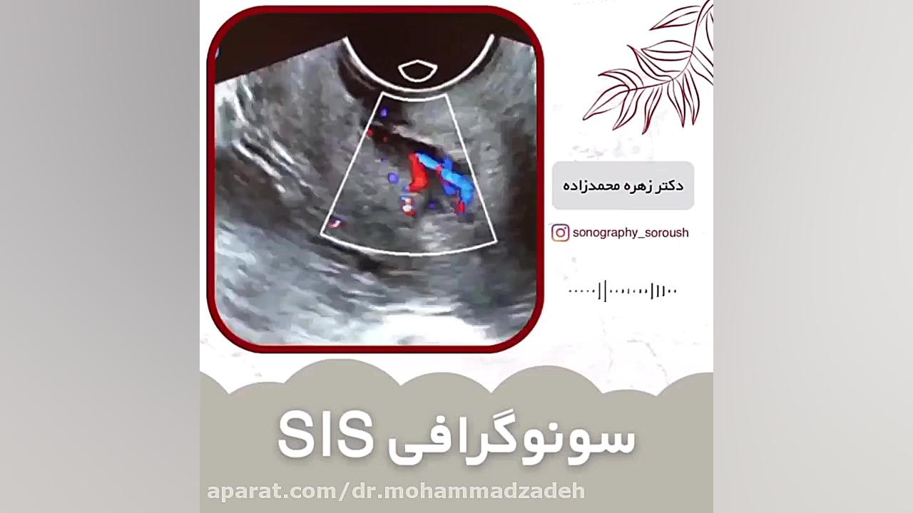 سونو گرافی SIS همراه با کالدگر داپلر اندومتر تزریق ژل